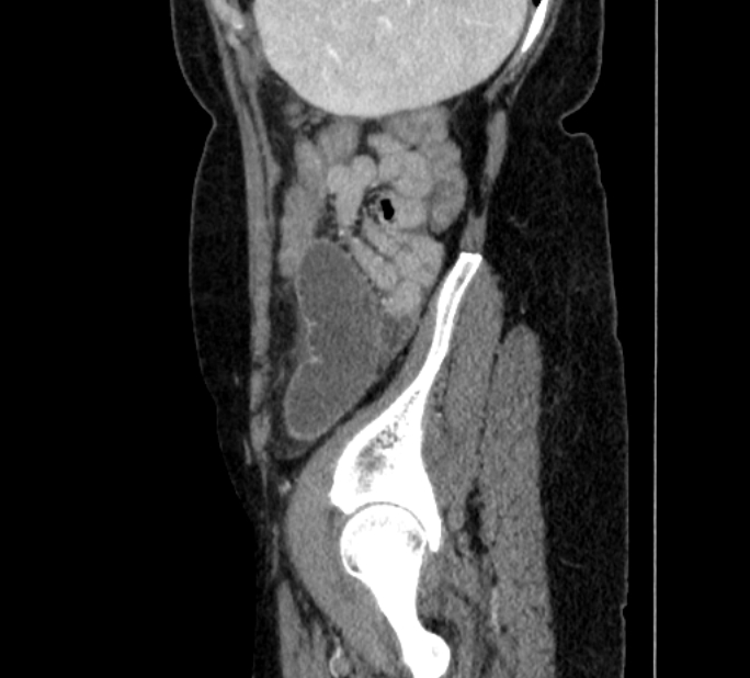Closed loop small bowel obstruction (Radiopaedia 71211-81508 C 144).jpg