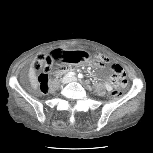 Closed loop small bowel obstruction - adhesions and infarct (Radiopaedia 85125-100678 B 60).jpg