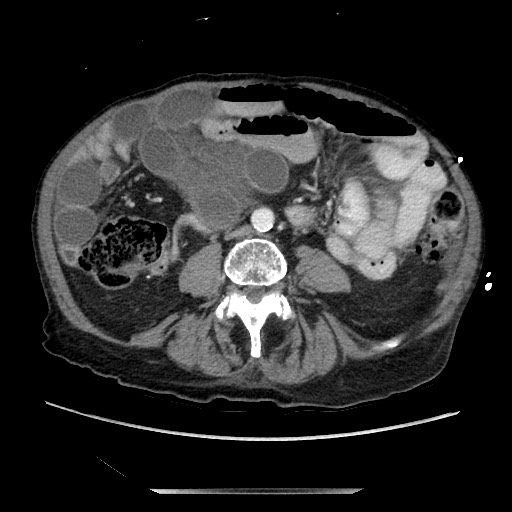 File:Closed loop small bowel obstruction - adhesive disease and hemorrhagic ischemia (Radiopaedia 86831-102990 A 110).jpg