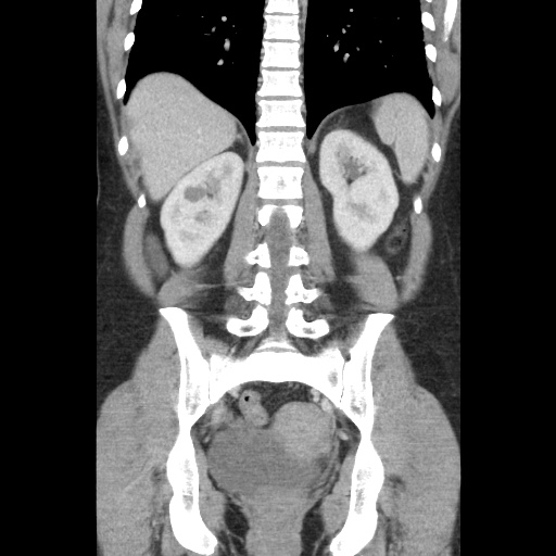 File:Closed loop small bowel obstruction due to trans-omental herniation (Radiopaedia 35593-37109 B 38).jpg