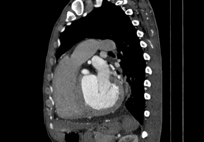Coarctation of aorta with aortic valve stenosis (Radiopaedia 70463-80574 B 104).jpg