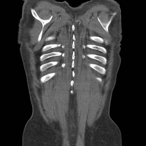 File:Coarctation of the aorta (Radiopaedia 17427-17116 A 10).jpg