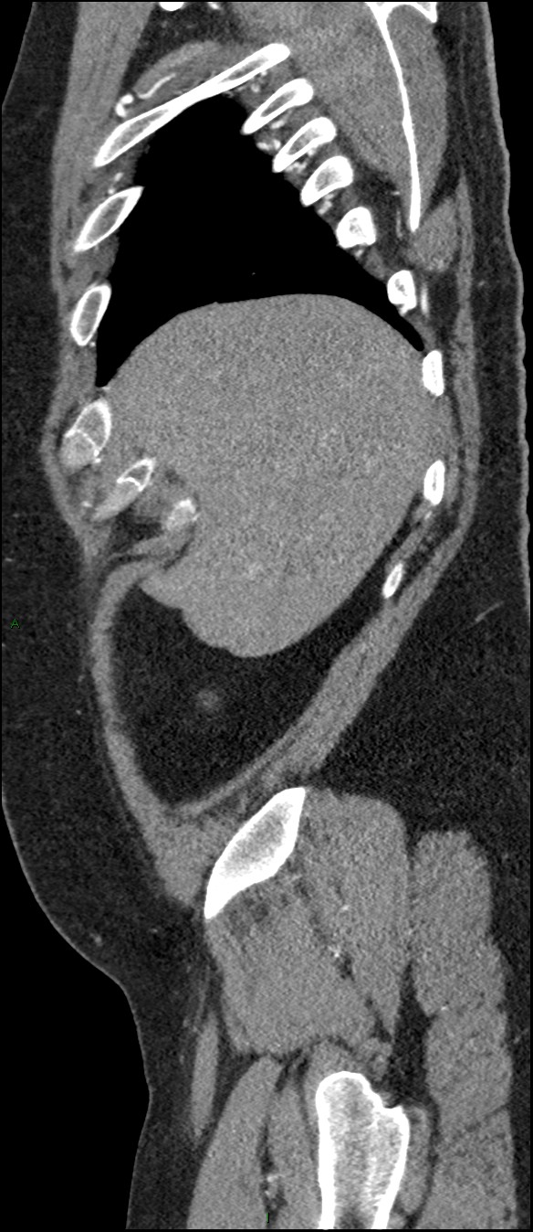 Coarctation of the aorta (Radiopaedia 74632-88521 C 37).jpg
