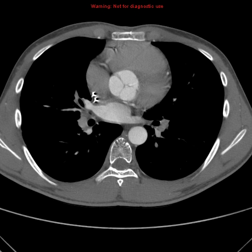 File:Coarctation of the aorta (Radiopaedia 9434-10118 A 100).jpg