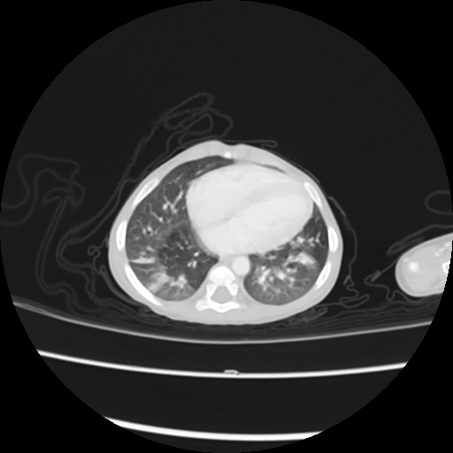 Coarctation of the aorta and patent ductus arteriosus (Radiopaedia 68033-77499 Axial lung window 43).jpg