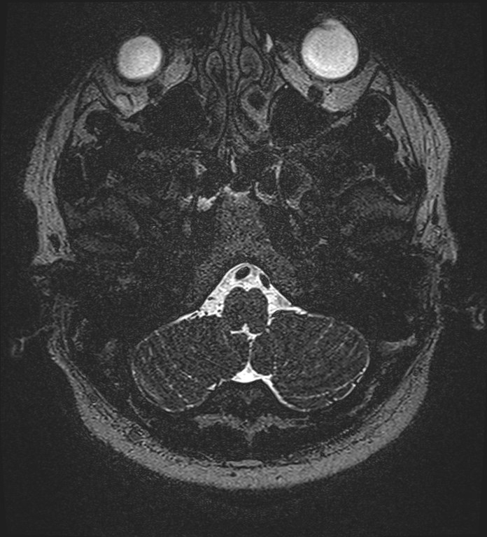 Cochlear incomplete partition type III associated with hypothalamic hamartoma (Radiopaedia 88756-105498 Axial T2 30).jpg