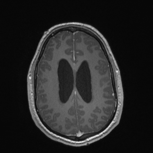 File:Colloid cyst (Radiopaedia 44510-48181 Axial T1 C+ 128).png