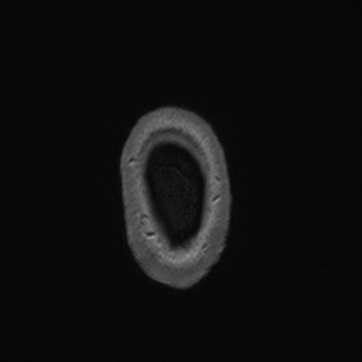 File:Colloid cyst (Radiopaedia 44510-48181 Axial T1 C+ 175).png