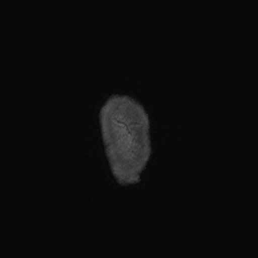File:Colloid cyst (Radiopaedia 44510-48181 Axial T1 C+ 182).png