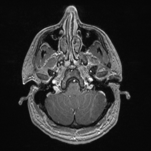 File:Colloid cyst (Radiopaedia 44510-48181 Axial T1 C+ 43).png