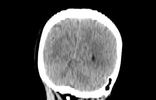 Colloid cyst (Radiopaedia 88663-105373 Coronal non-contrast 55).jpg