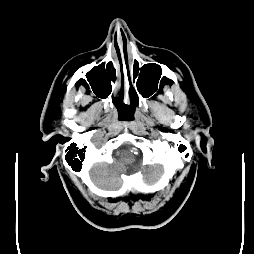 File:Colloid cyst (large) (Radiopaedia 34415-35734 Axial non-contrast 10).png