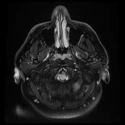 File:Colloid cyst with anterior communicating artery aneurysm (Radiopaedia 33901-35091 Axial FLAIR 1).jpg