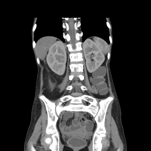 File:Colocolic fistula - Crohn disease (Radiopaedia 57063-63955 B 32).jpg