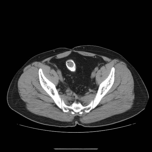 File:Colocutaneous fistula in Crohn's disease (Radiopaedia 29586-30093 D 32).jpg
