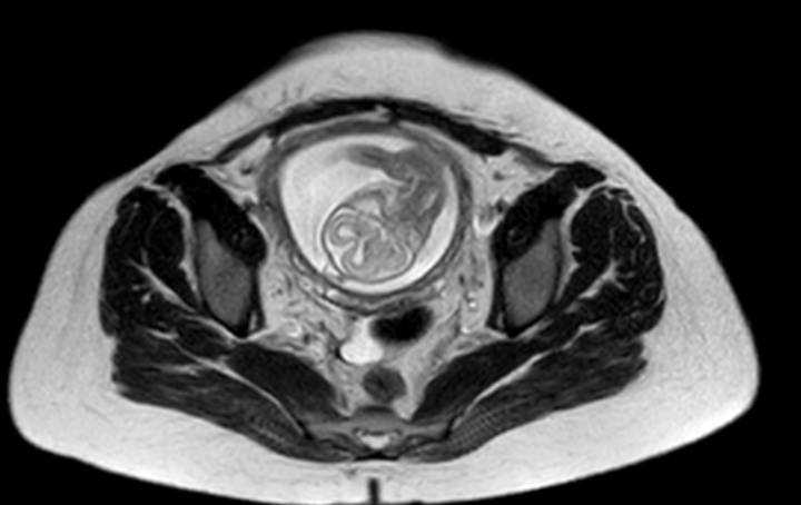 Colon adenocarcinoma with Krukenberg tumors, advanced pregnancy (Radiopaedia 67279-76645 Axial T2 14).jpg