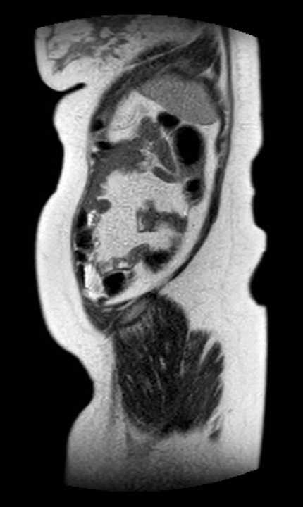 Colon adenocarcinoma with Krukenberg tumors, advanced pregnancy (Radiopaedia 67279-76645 Sagittal T2 7).jpg