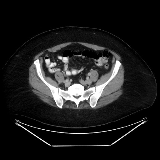 File:Colonic intussusception due to adenocarcinoma (Radiopaedia 86828-102987 A 111).jpg