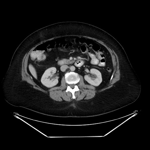 File:Colonic intussusception due to adenocarcinoma (Radiopaedia 86828-102987 Axial 41).jpg