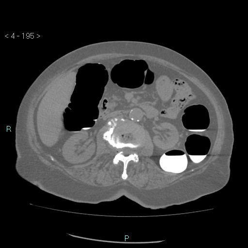 Colonic lipomas (Radiopaedia 49137-54244 Axial bone window 87).jpg