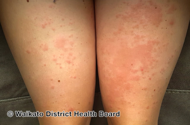 File:Contact dermatitis due to isocyanate (DermNet NZ contact-dermatitis-isocyanate-05).jpg