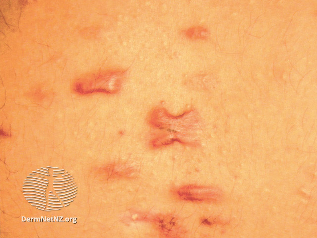 File:Keloid scar (DermNet NZ dermal-infiltrative-keloid13).jpg
