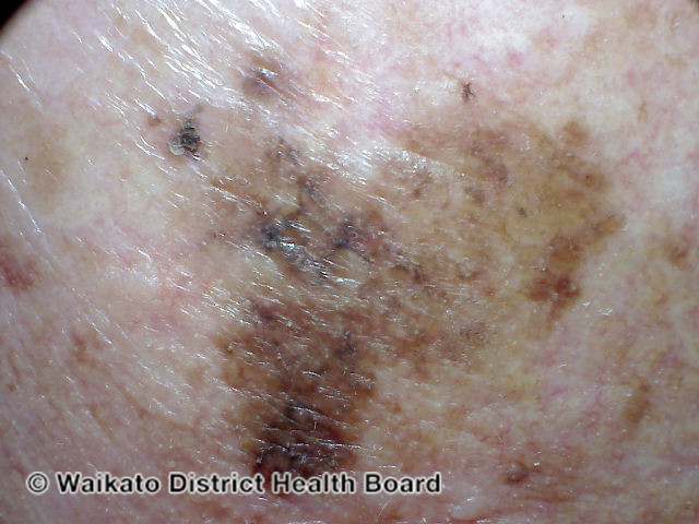 File:Melanoma with mixed sharp and fading border (DermNet NZ melanoma-abcd-05).jpg