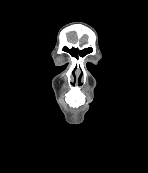 Nasal pyogenic granuloma (lobular capillary hemangioma) (Radiopaedia 85536-101244 D 45).jpg