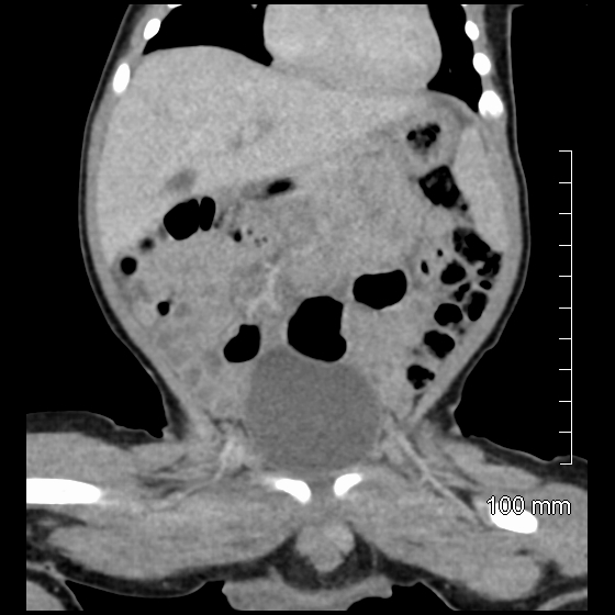 File:Neonatal neuroblastoma (Radiopaedia 56651-63438 Coronal non-contrast 21).jpg