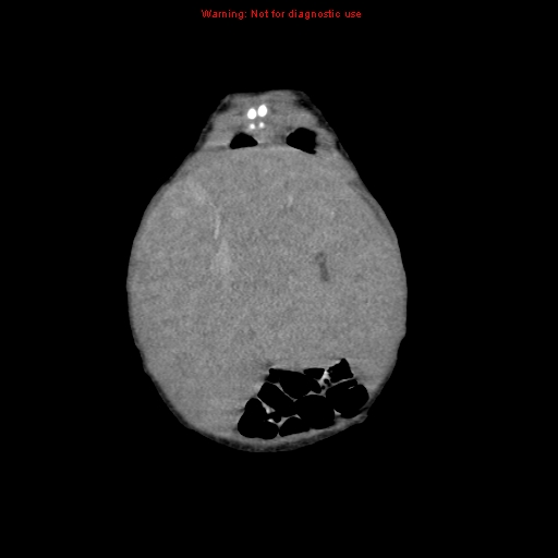 File:Neonatal neuroblastoma (Radiopaedia 9564-10223 B 25).jpg
