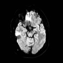 File:Neuro-Behcet's disease (Radiopaedia 21557-21506 Axial DWI 11).jpg