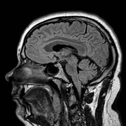 File:Neuro-Behcet's disease (Radiopaedia 21557-21506 Sagittal FLAIR 18).jpg