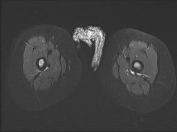 File:Neuroblastoma with bone metastases (Radiopaedia 67080-76414 Axial STIR 32).jpg