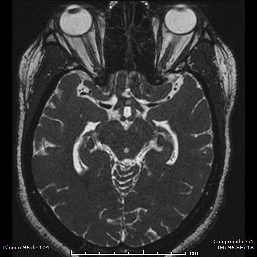 Neurocysticercosis (Radiopaedia 58636-65832 I 96).jpg