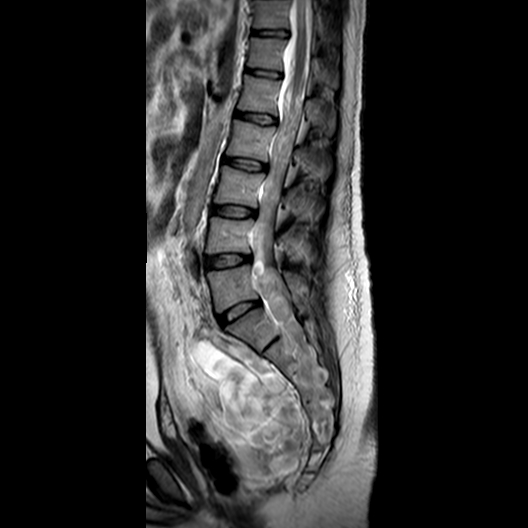File:Neurofibromatosis type 1- extensive spinal involvement and Christmas tree sign (Radiopaedia 60610-68332 Sagittal T2 8).jpg
