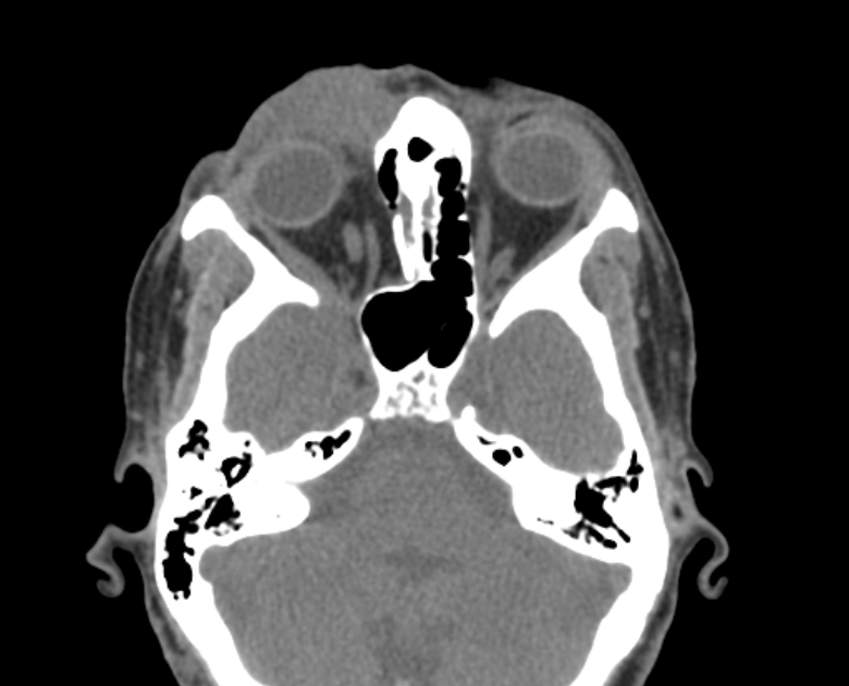 Neurofibromatosis type 1- orbital manifestations (Radiopaedia 49391-54511 Axial non-contrast 50).jpg
