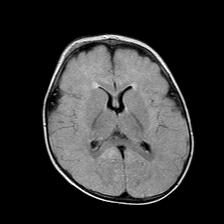File:Neurofibromatosis type 1 (Radiopaedia 30089-30671 Axial FLAIR 13).jpg