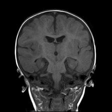 File:Neurofibromatosis type 1 (Radiopaedia 30089-30671 Coronal T1 16).jpg