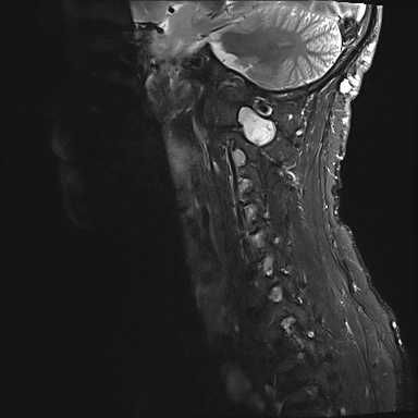 File:Neurofibromatosis type 1 (Radiopaedia 80355-93740 Sagittal STIR 1).jpg