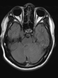 File:Neurofibromatosis type 2 (Radiopaedia 44936-48838 Axial FLAIR 7).png