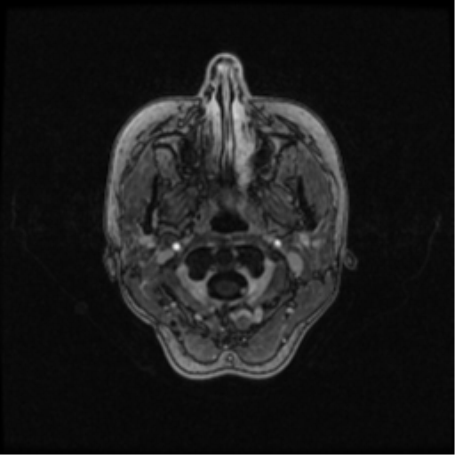Neurofibromatosis type 2 (Radiopaedia 45229-49244 Axial T1 C+ 17).png