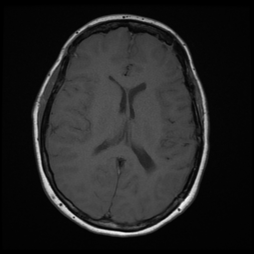 File:Neurofibromatosis type 2 (Radiopaedia 45229-49247 Axial T1 13).png