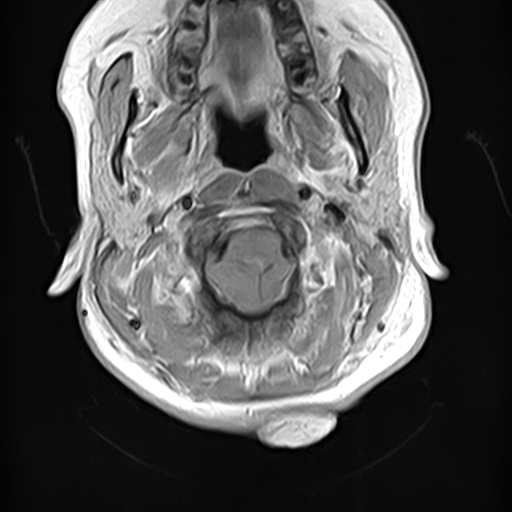File:Neurofibromatosis type 2 (Radiopaedia 66211-75403 Axial T1 C+ 2).jpg