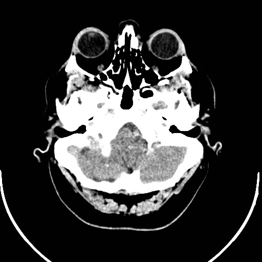 Neurofibromatosis type 2 (Radiopaedia 79097-92047 Axial non-contrast 9).jpg