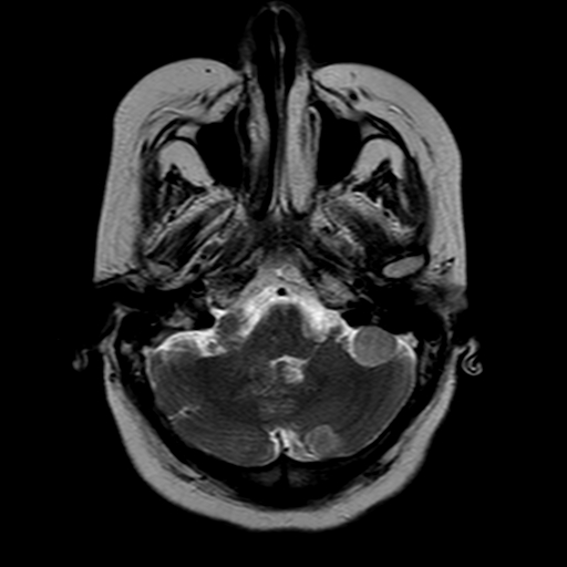 File:Neurofibromatosis type 2 (Radiopaedia 8713-9518 Axial T2 20).jpg