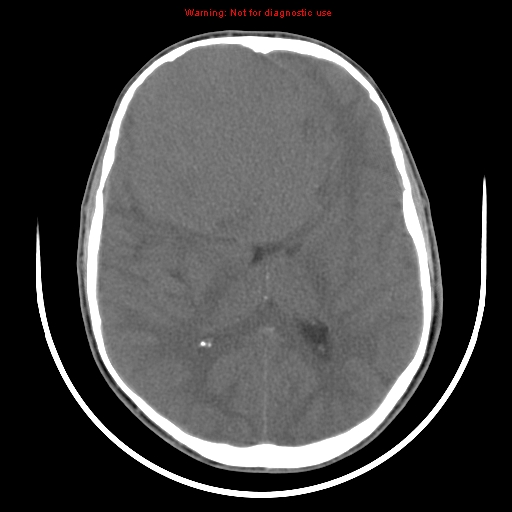 File:Neurofibromatosis type 2 (Radiopaedia 8953-9732 Axial non-contrast 20).jpg