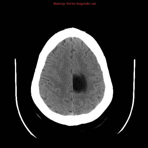 File:Neuroglial cyst (Radiopaedia 10713-11185 Axial non-contrast 8).jpg