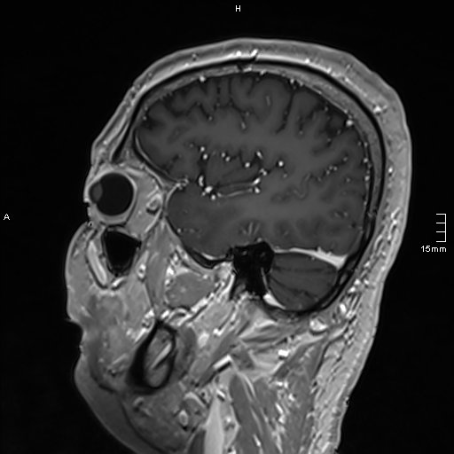 Neurosarcoidosis - involvement of the mesial temporal lobes (Radiopaedia 67429-76820 Sagittal T1 C+ 44).jpg