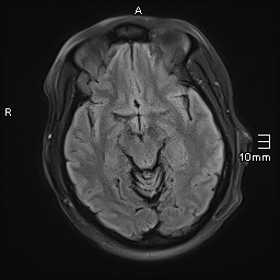 File:Neurotoxoplasmosis - concentric target sign (Radiopaedia 70644-80784 Axial FLAIR 9).jpg