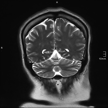File:Neurotoxoplasmosis - concentric target sign (Radiopaedia 70644-80784 Coronal T2 14).jpg